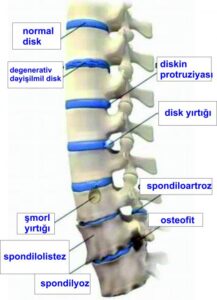feqerearasi disk yirtiqlari 5552